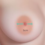 5 cm Areolas